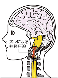 圧迫